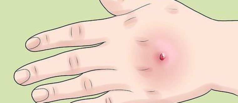 החיידק MRSA Staph