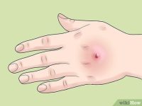 How to Test for MRSA_ 10 Steps (with Pictures) - wikiHow